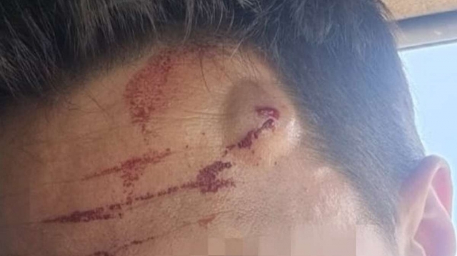 Las heridas de un guardia civil agredido con un gancho en un intento de salto a la valla de Ceuta