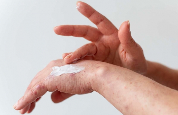 Eczema crónico de manos, una afección recurrente que conviene tratar en fases iniciales