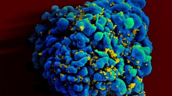 La terapia contra el VIH puede acelerar el envejecimiento